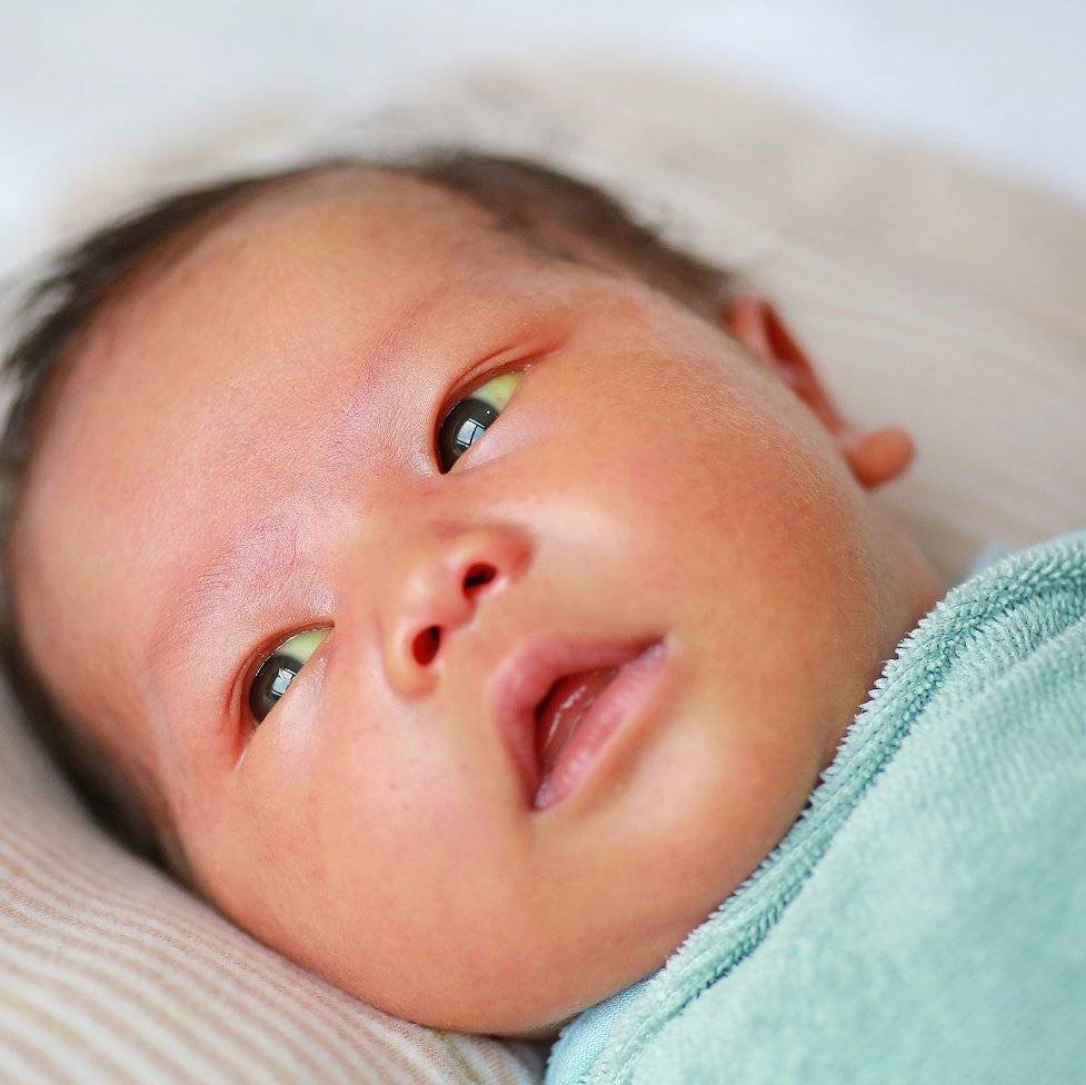 სიყვითლე, ბილირუბინი, 